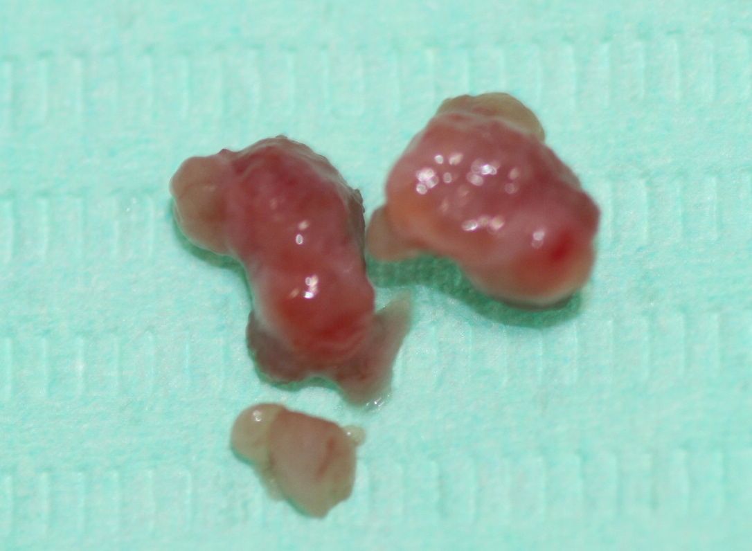 Aspecto del mucocele labial extraído al paciente