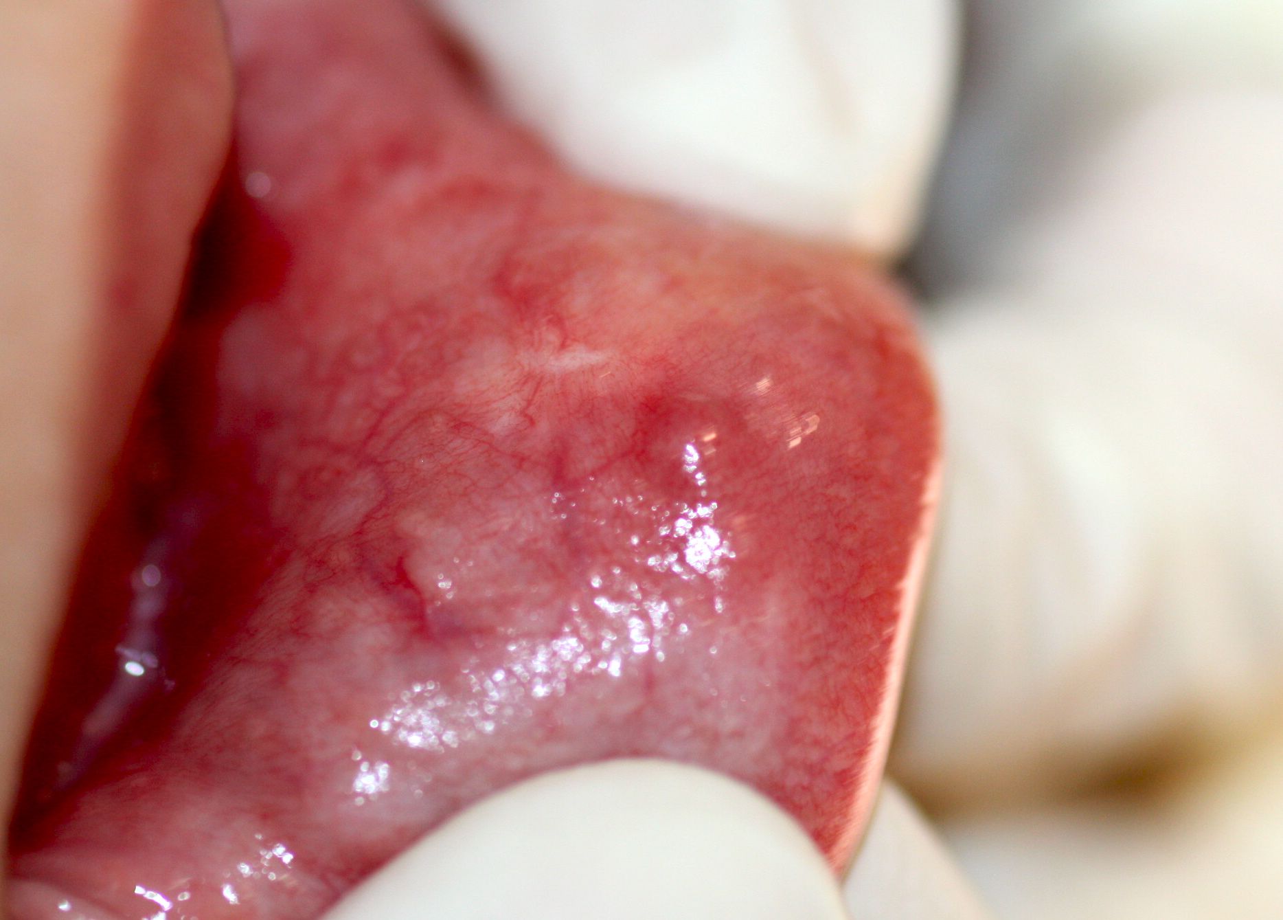 El mucocele se detecta fácilmente a la exploración como un 'bulto' en tejido labial
