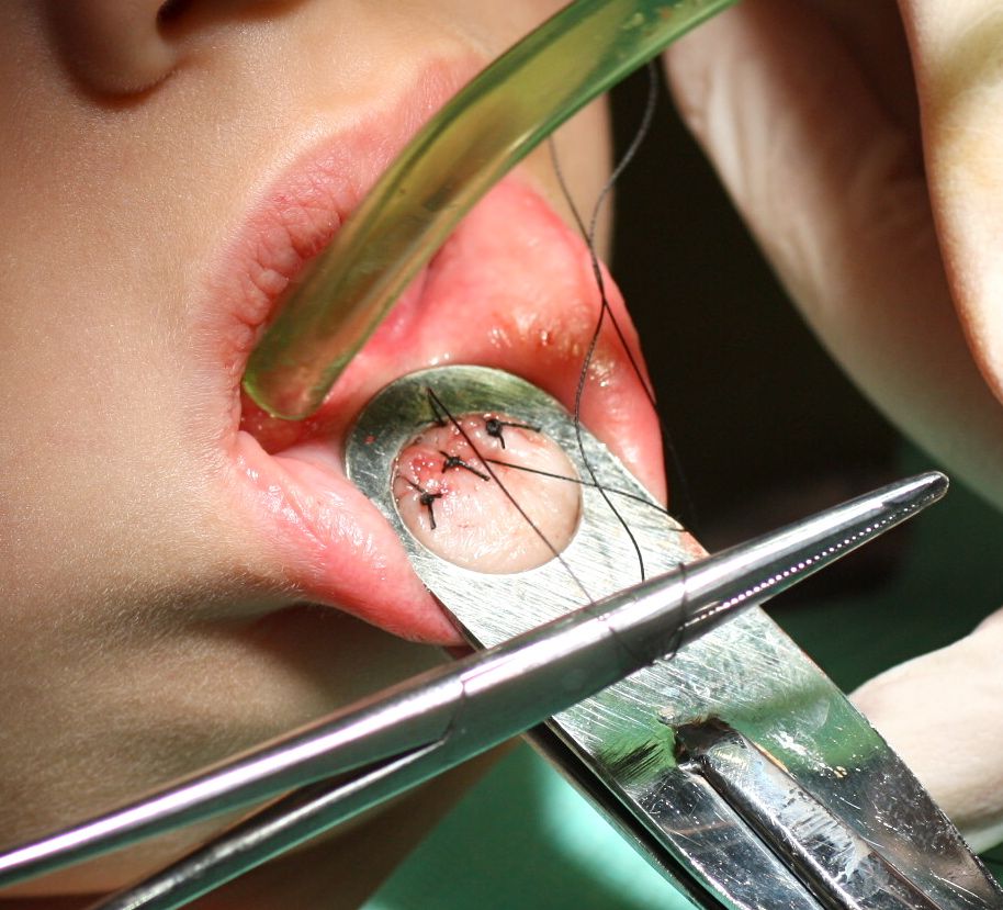 Es importante suturar el labio con puntos que retiraremos a los 7-10 días de la cirugía oral