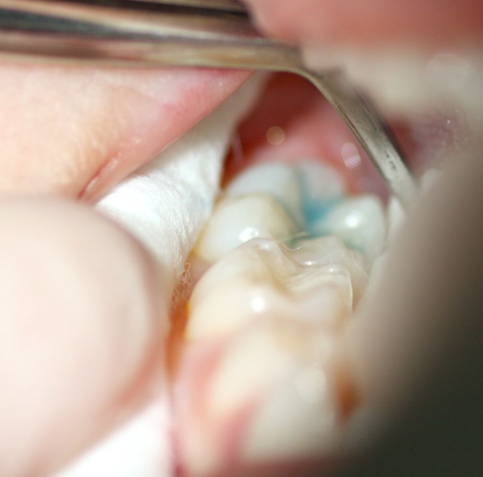 Permanent molar etching with orthophosphoric acid 37%