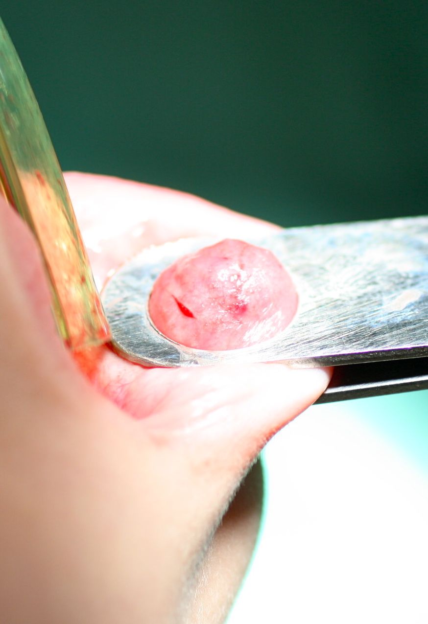 La incisión permite la exéresis del mucocele de forma sencilla