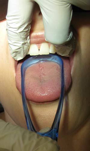 El uso de un raspador lingual facilita la remoción mecánica de bacterias en el dorso de la lengua