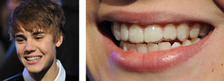 Sonrisa Justin Bieber gracias a Invisalign Teen