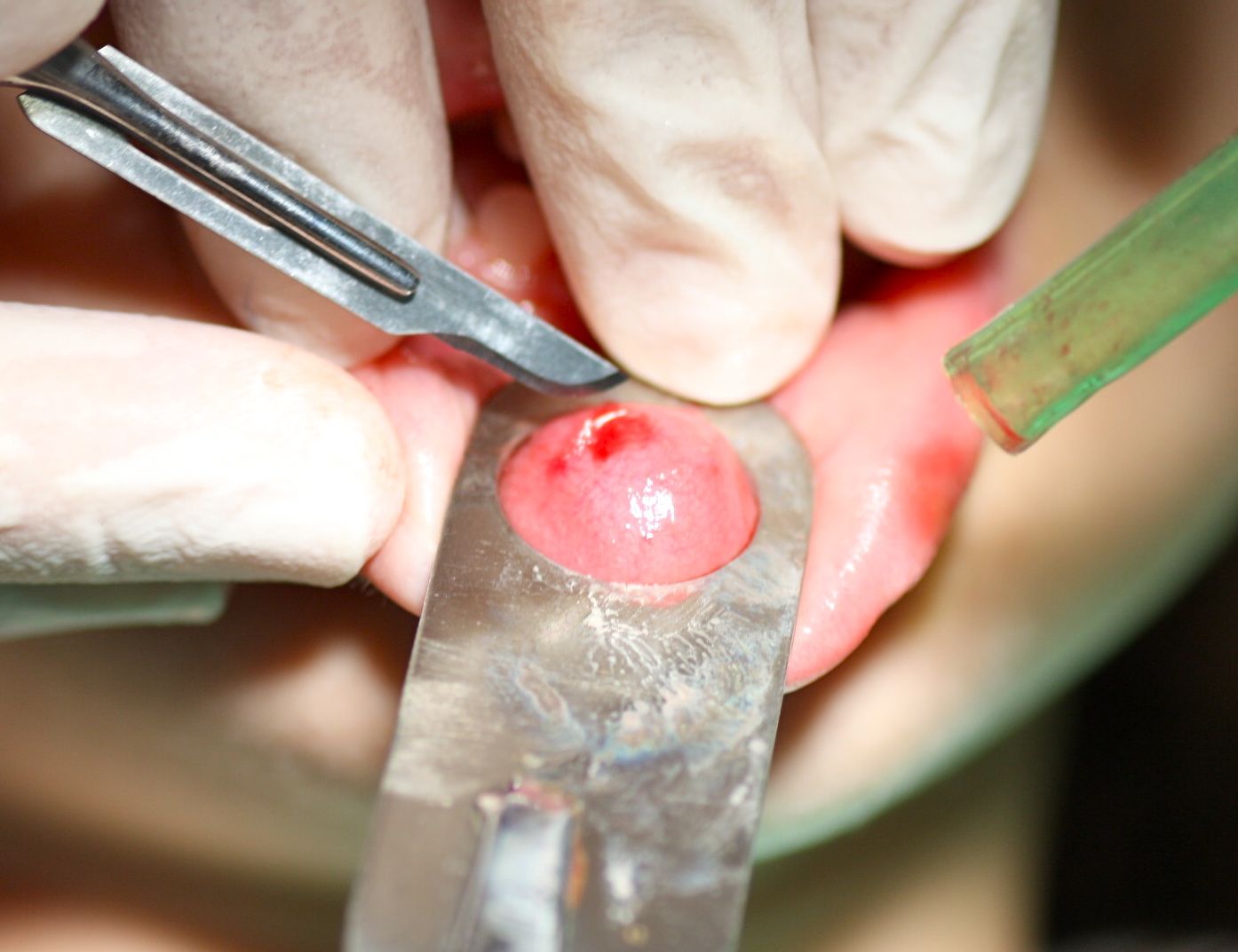 Una incisión mínimamente invasiva permite enuclear un mucocele convencional