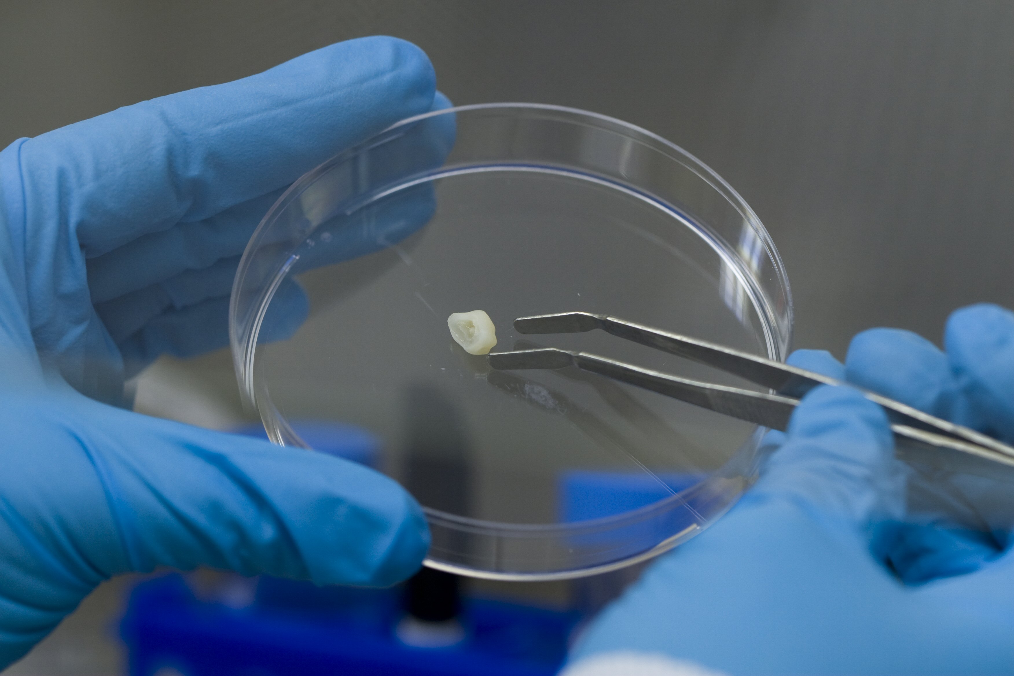La extracción de un diente temporal permite almacenar sus células madre para el futuro