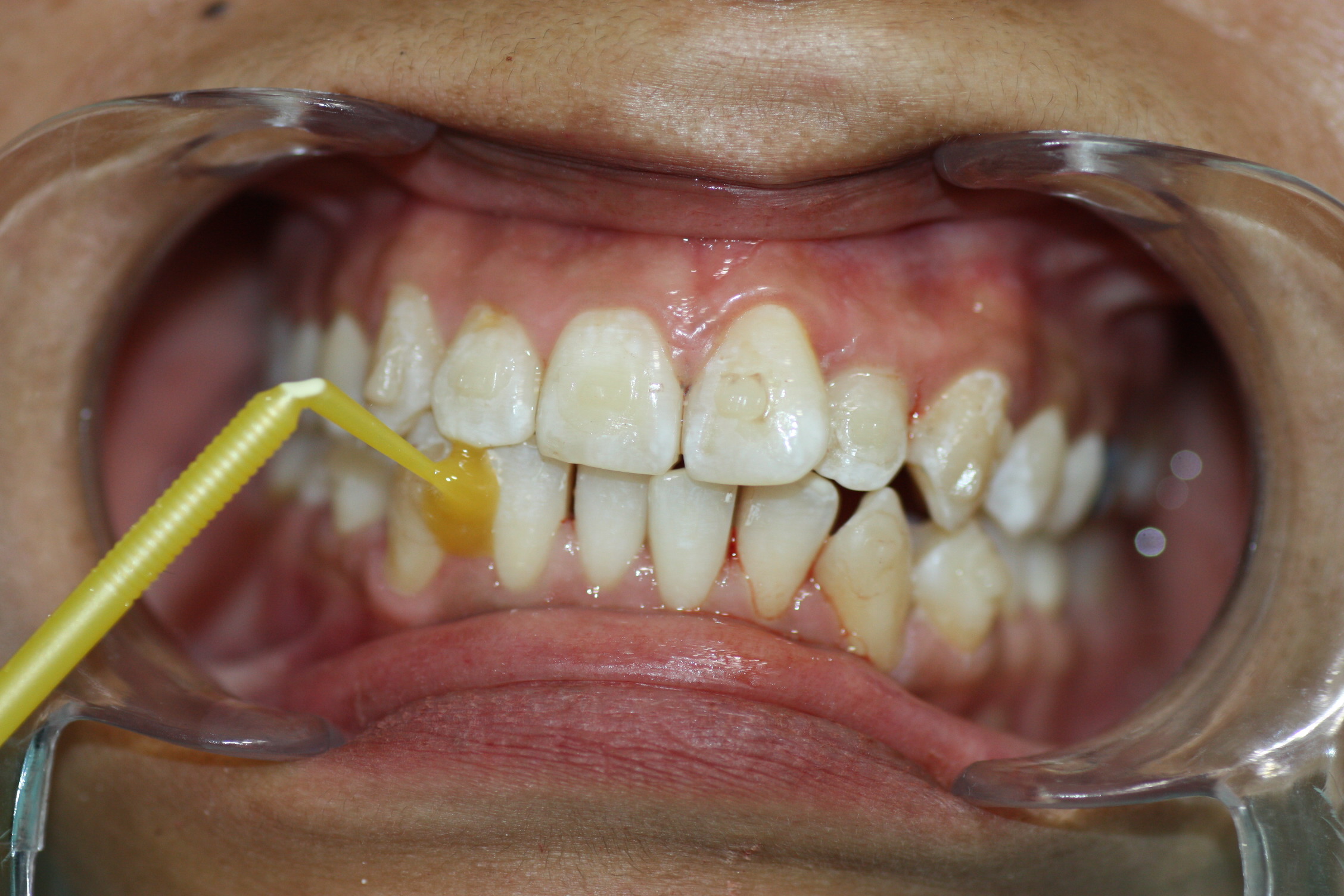 Application of interproximal fluoride after stripping