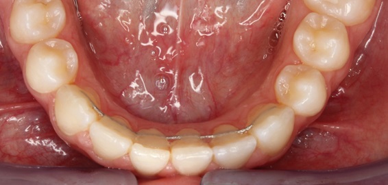 La retención fija con alambre coaxial de acero trenzado es cómoda y fiable para mantener alineados los dientes
