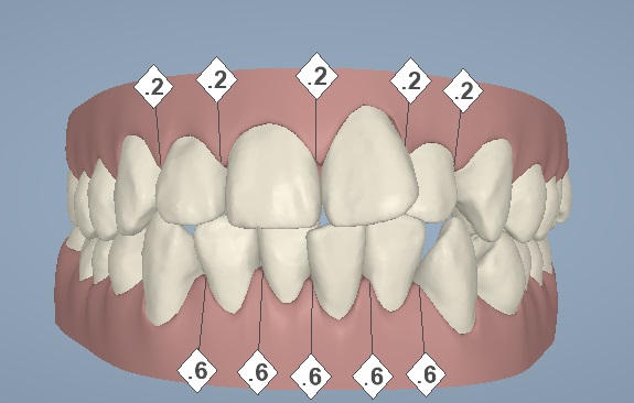 La planificación del 'stripping' con la técnica Invisalign es realmente precisa gracias al software Clincheck