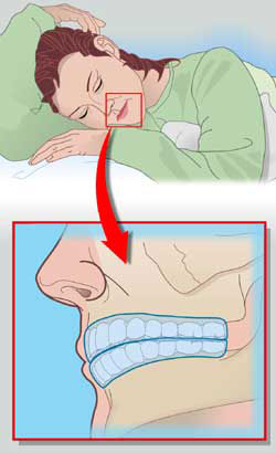 Nocturnal bruxism is of great importance as it is beyond the patient's control.