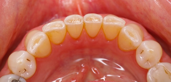 Enamel wear is one of the most frequent effects in bruxing patients.