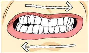 El rechinamiento dental o bruxismo es un hábito nocivo para nuestra salud bucodental