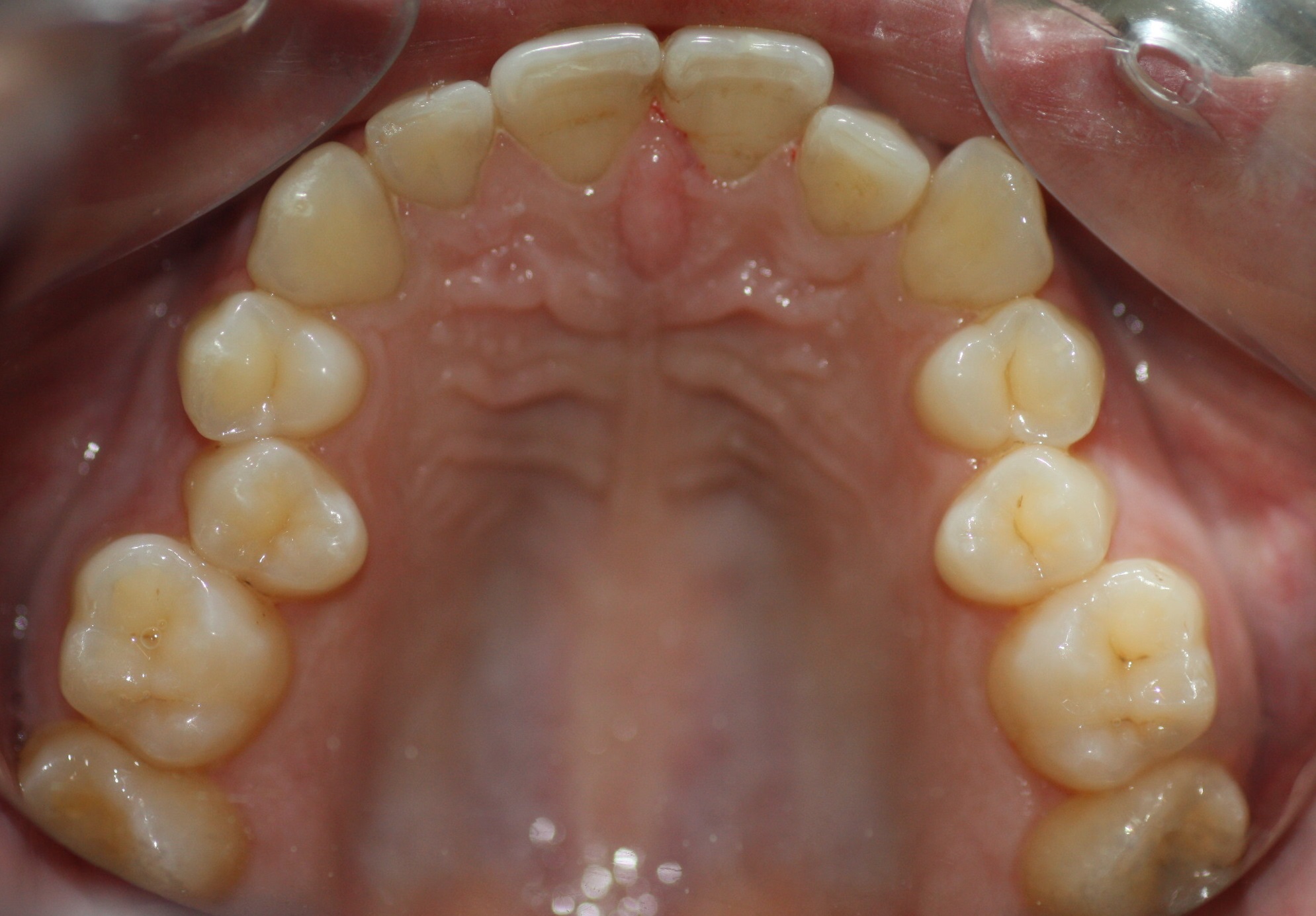 1. Teeth-Upper-Arcade-Orthodontics-Lingual-Incognitus-Murcia