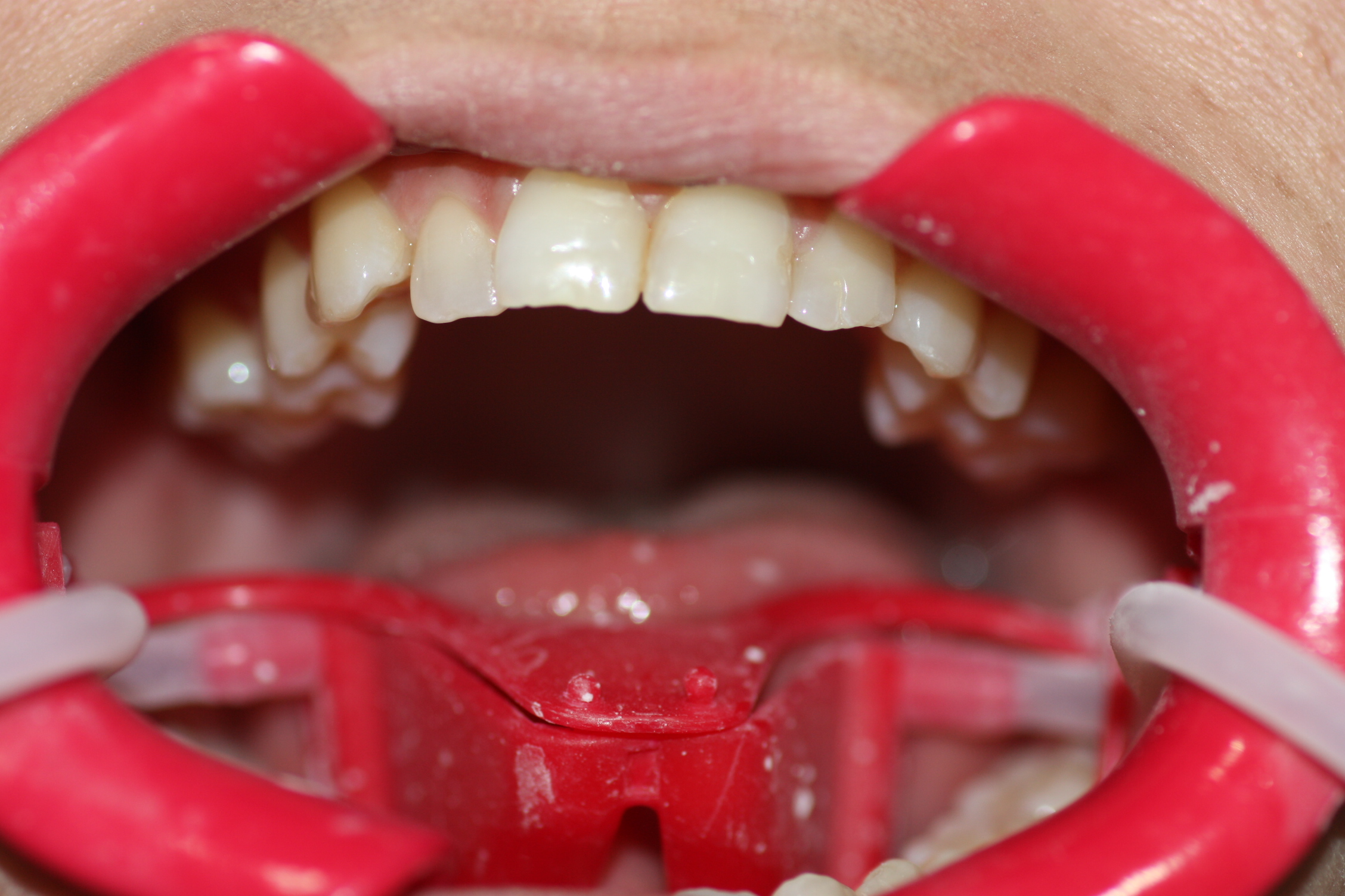 2. Mouth-opener-Nola-Aspiration-Dental-Dental-Orthodontics-Lingual-Incognito-Murcia