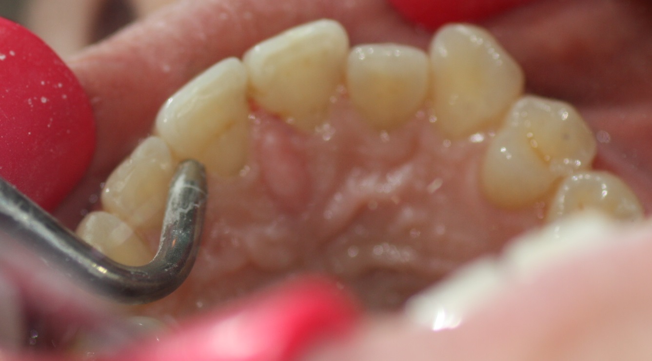 3. Micro-sandblasting-Dental-Sandblasting-Dental-Incognito-Cementation-Murcia-Orthodontic-Lingual
