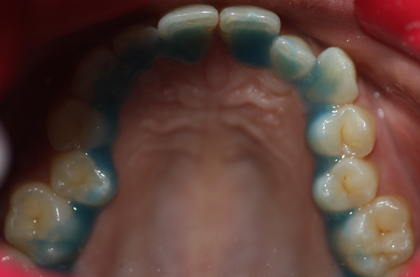 4. Engraving-Dental-Acid-Orthophosphoric-Orthodontics-Lingual-Incognito-Murcia