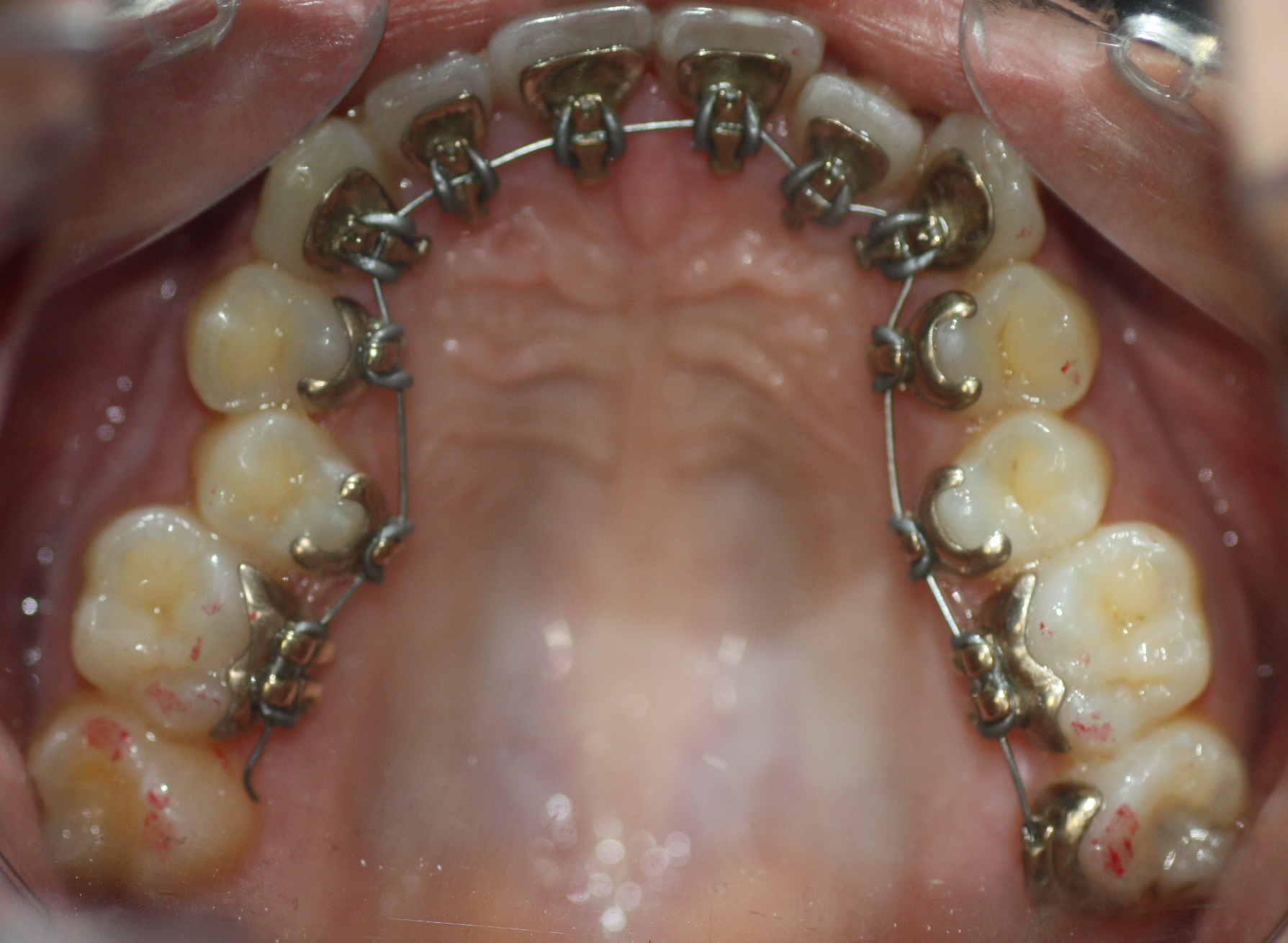 7. Cemented-Lingual-Brackets-Invisible-Esthetic-Incognito-3M-Murcia-Gold