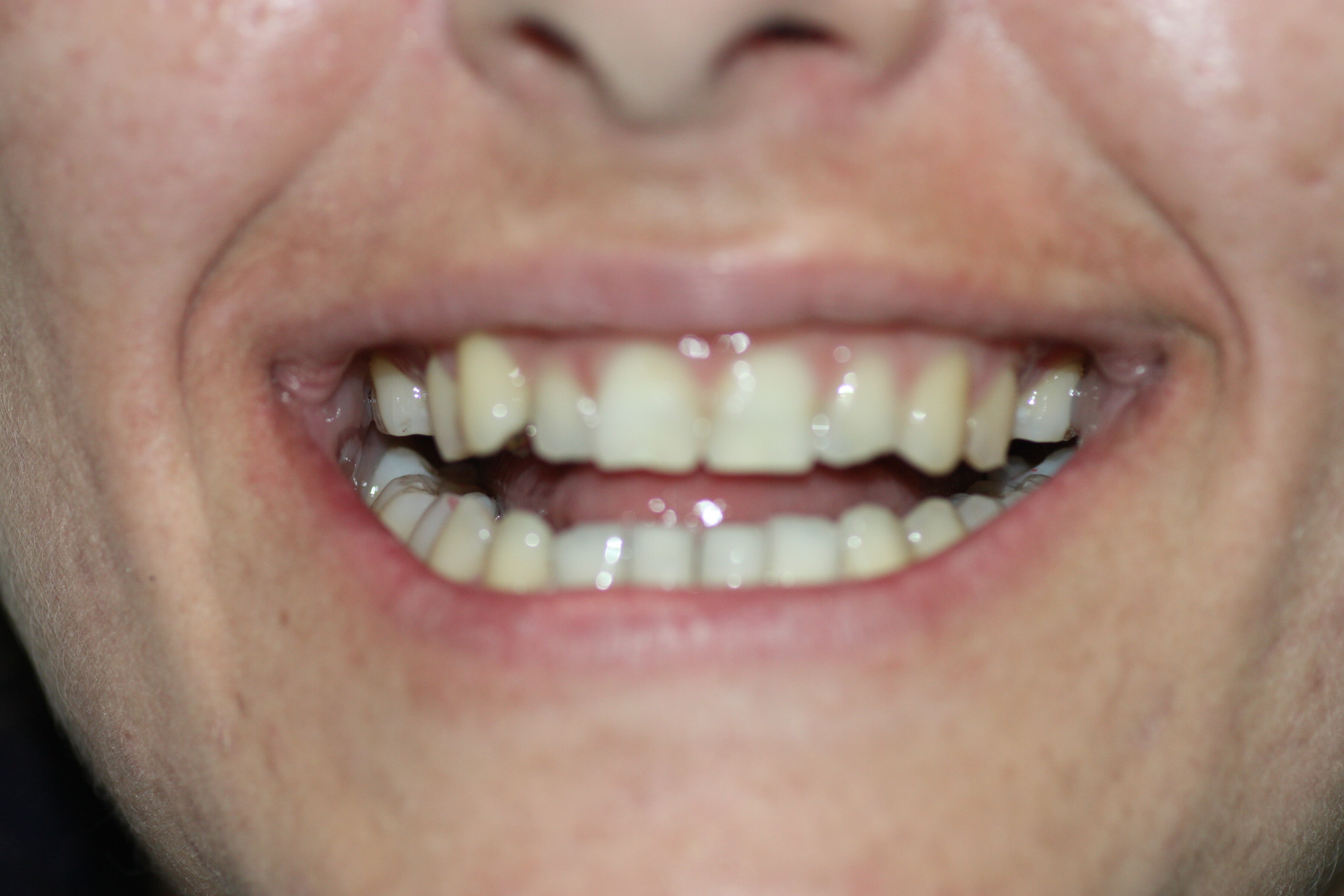 8. Bracket-Lingual-Incognito-3M-Orthodontics-Murcia-Sonrisa-Invisible-Esthetics