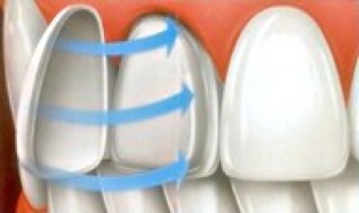 Veneer-Dental-Murcia-Aesthetics