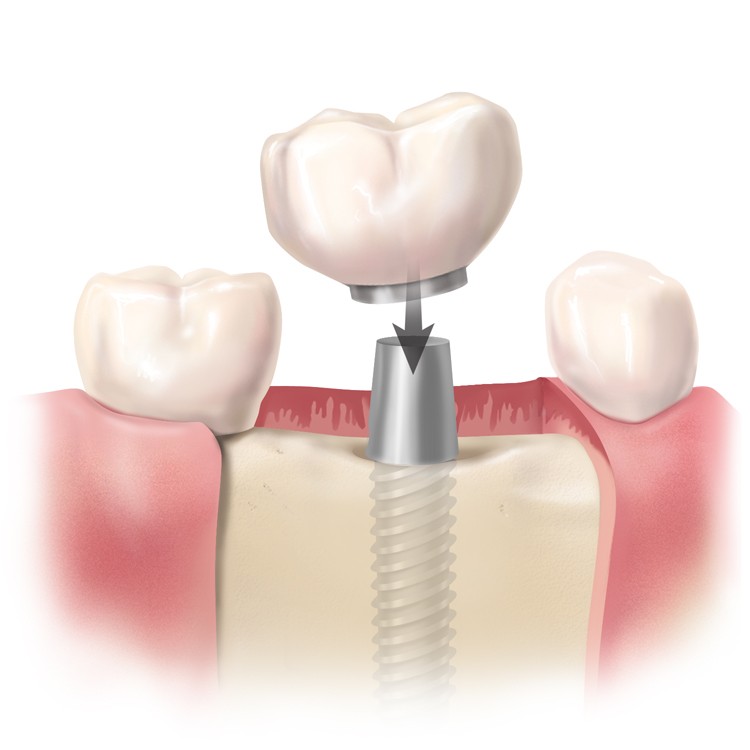 Implant-Dental-Crown-Dentist-Dentist-Oral-Surgeon-Murcia