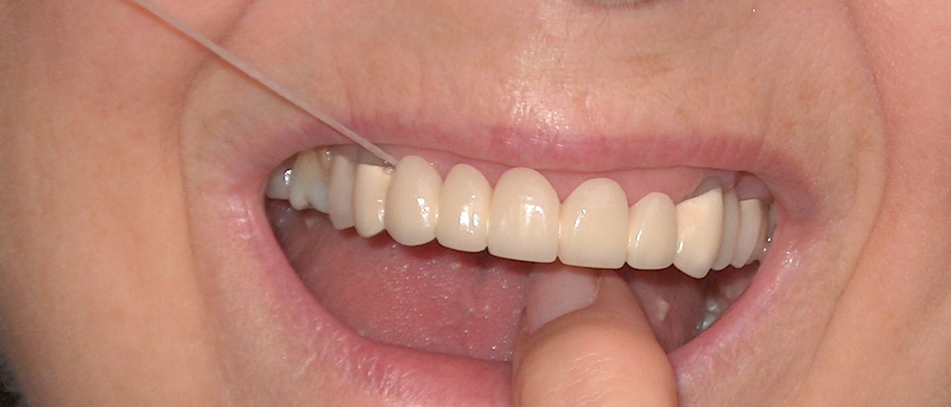 Superfloss-Bridge-Implant-Murcia