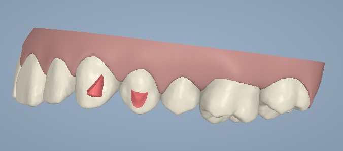El software 3D permite que el ortodoncista qué dientes necesitarán 'attachments'