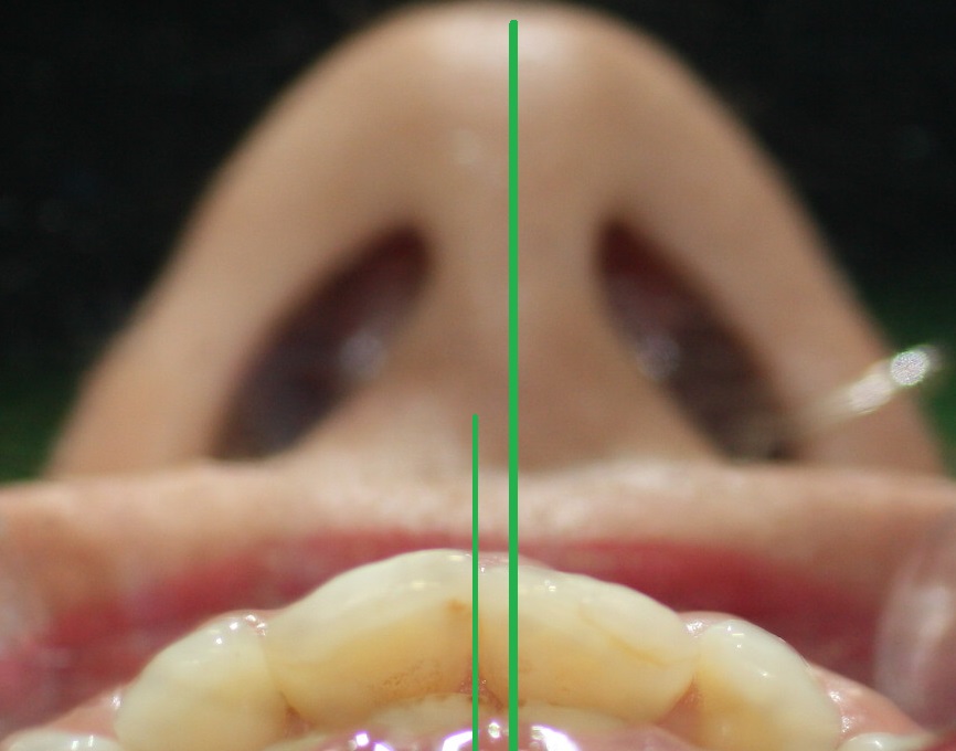 1a. Linea-Media-Dental-Nasal-Facial-Ortodoncia-Nariz-Invisalign