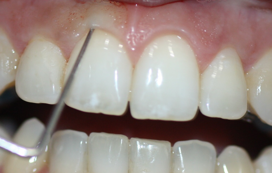 El sondaje por parte de un periodoncista es imprescindible en estos casos
