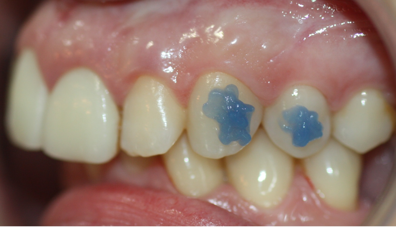 The orthodontist will apply the orthophosphoric gel to the area where the attachment is to be placed.