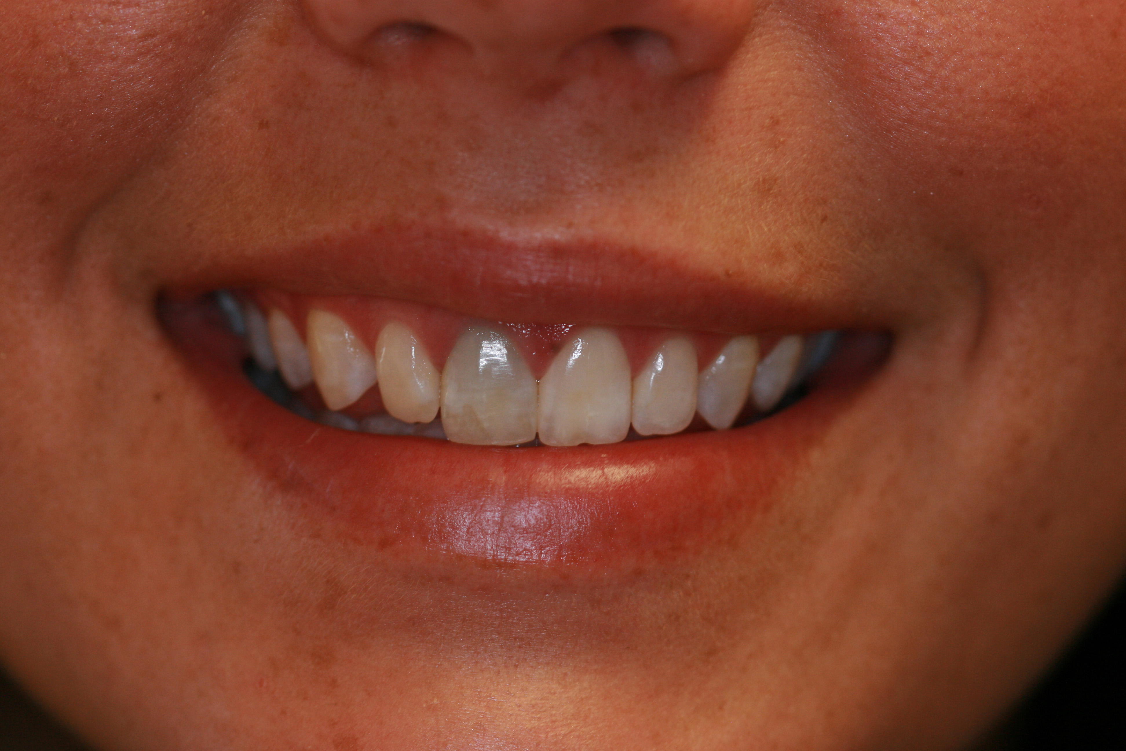 Una tinción dental puede afectar mucho a la estética de nuestra sonrisa, con efectos sociales importantes