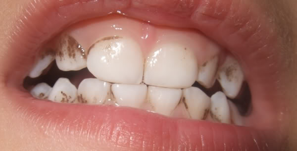 Brown stains on teeth are particularly common in childhood.