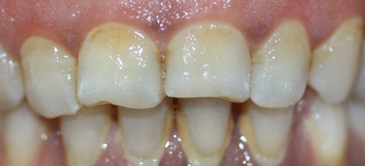 White spots, the result of plaque build-up, are easily removed by brushing.
