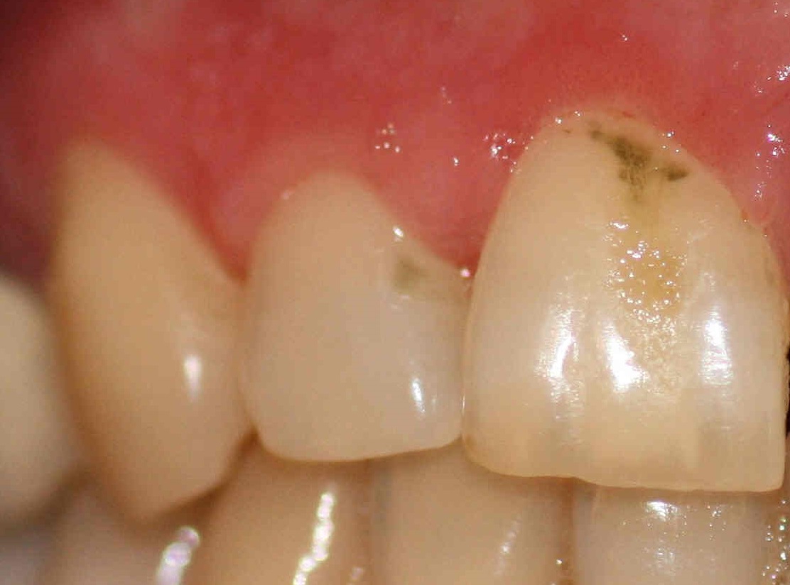 A green stain on the teeth is caused by bacteria and fungi such as the bacillus pyocyanus or the fungus Penicillium glaucum.