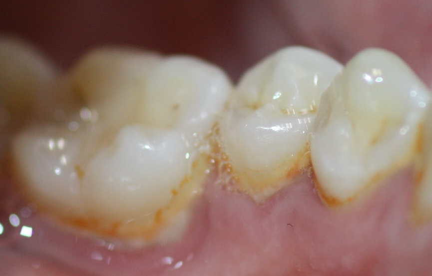 Orange stains are easily removed by cleaning.