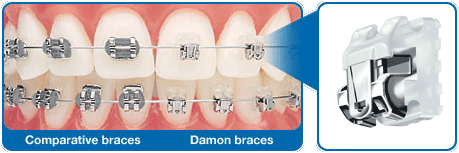 Los brackets Damon son una referencia en materia de ortodoncia autoligable