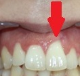 Además de tener un impacto estético para el paciente, esta recesión provocará hipersensibilidad dental