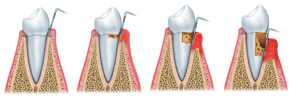 Periodontics-Arthritis-Alzheimer's disease-Diabetes-Murcia-Dentist-Gingivitis
