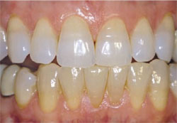 Diente-Color-Edad-Dentista-Murcia