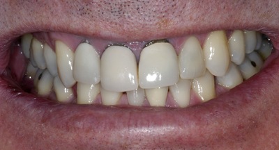 La recesión dental puede suponer un problema estético considerable en pacientes con fundas dentales