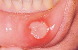 afta-mucosa-oral-dentista-murcia.png