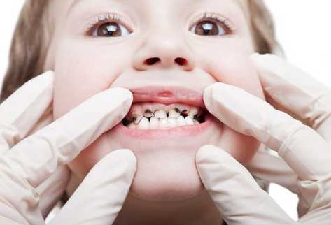 dieta-sana-caries-niños-2