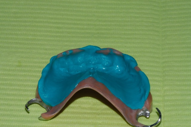 Prótesis-Acrílica-Dentista-Murcia-Dentadura