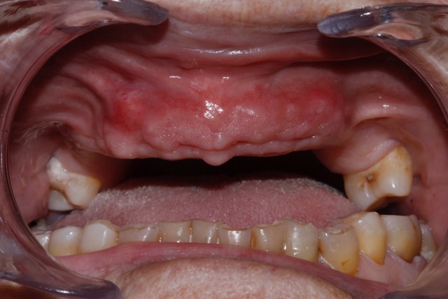 Úlcera-Prótesis-Mucosa-Dental-Paciente-Dentadura-Completa-Murcia.jpeg