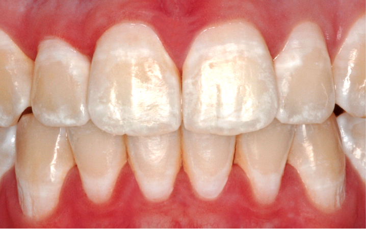 velez-y-lozano-manchas-blancas-caries