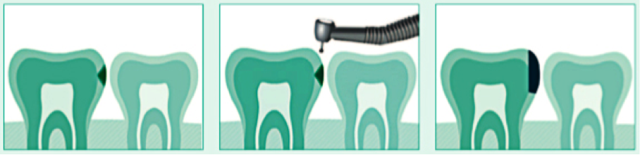 velez-y-lozano-manchas-caries